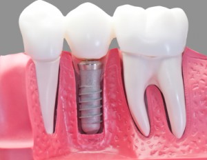 Servicios Odontológicos: Implantes
