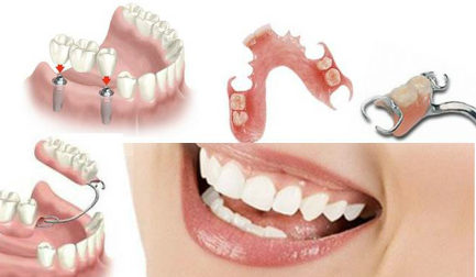 Servicios Odontologicos - Prótesis dentaria