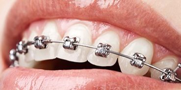 Servicios Odontológicos - Ortodoncia